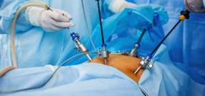 Gastric Laparoscopic Stomach Sleeve